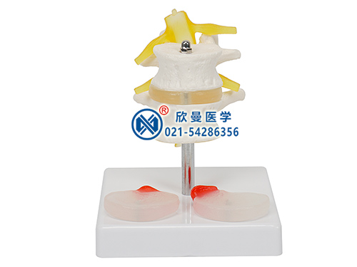 XM-135D2節(jié)腰椎附2個(gè)病變椎間盤(pán)模型